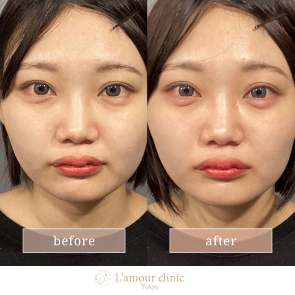 涙袋ヒアルロン酸