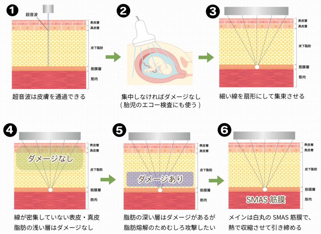 ハイフの仕組み