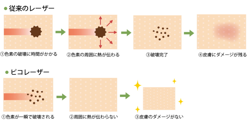 ピコレーザーと従来のレーザーの違い図解