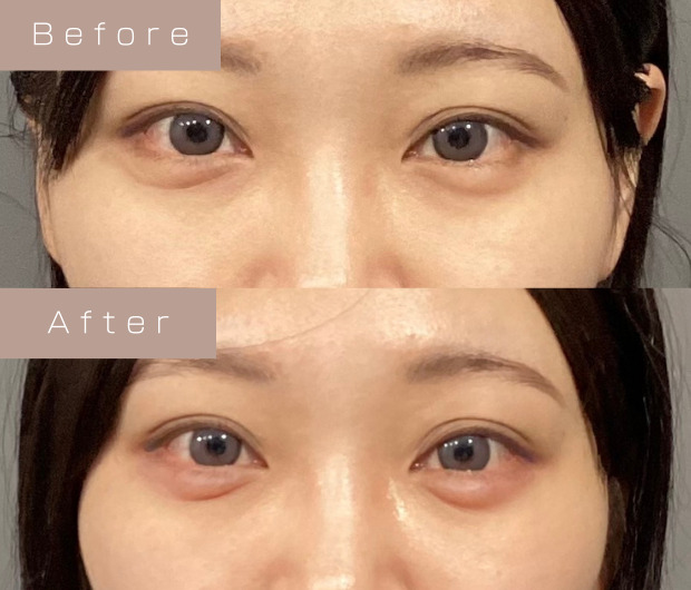 涙袋ヒアルロン酸