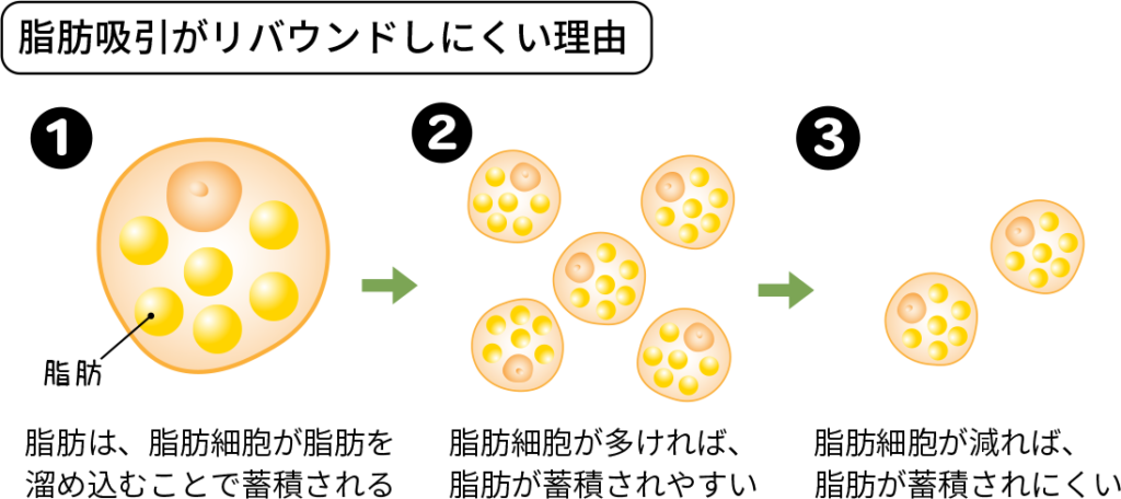 脂肪吸引がリバウンドしにくい理由