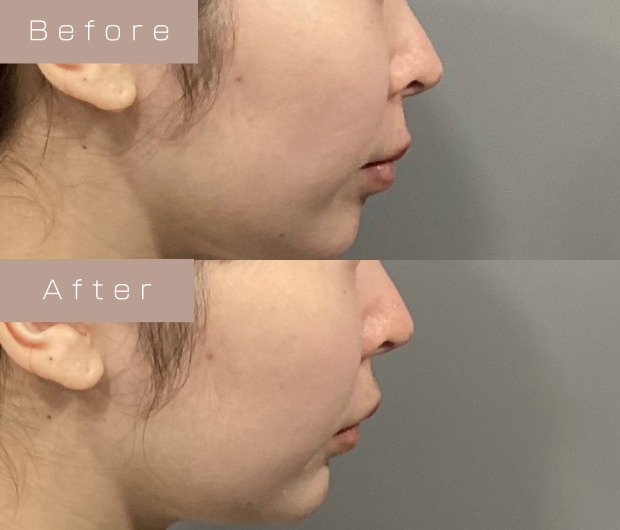 顎ヒアルロン酸