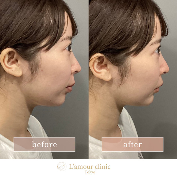 顎ヒアルロン酸