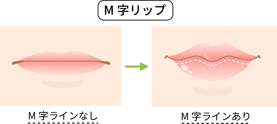 M字リップ