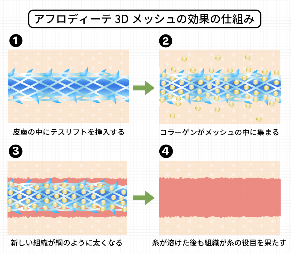 アフロディーテ3Dメッシュの効果の仕組み