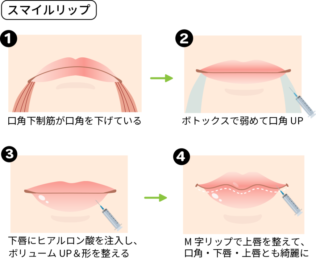 スマイルリップ図解
