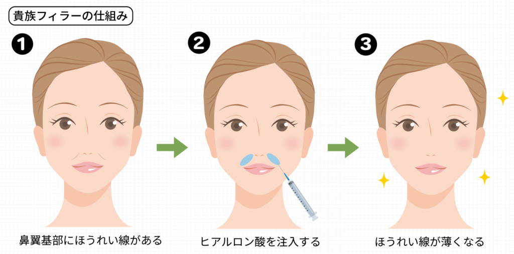 貴族フィラーの仕組み