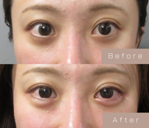 涙袋ヒアルロン酸