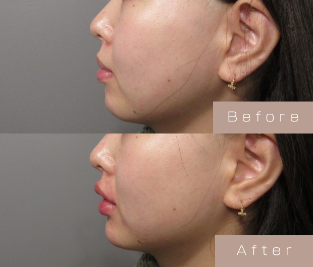 顎ヒアルロン酸