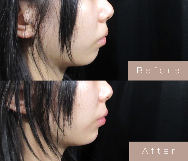 顎ヒアルロン酸