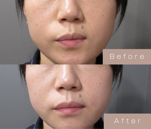 ほうれい線ヒアルロン酸