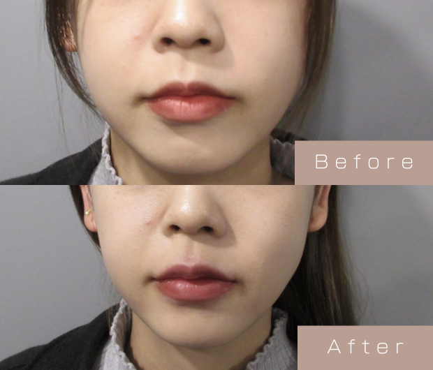 スマイルリップ