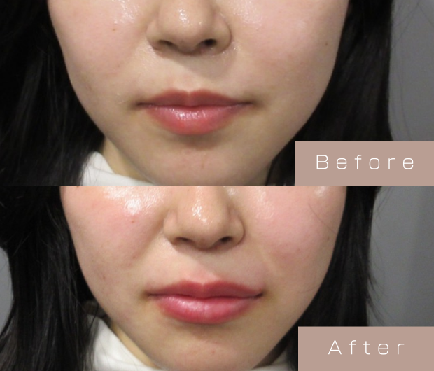 スマイルリップ