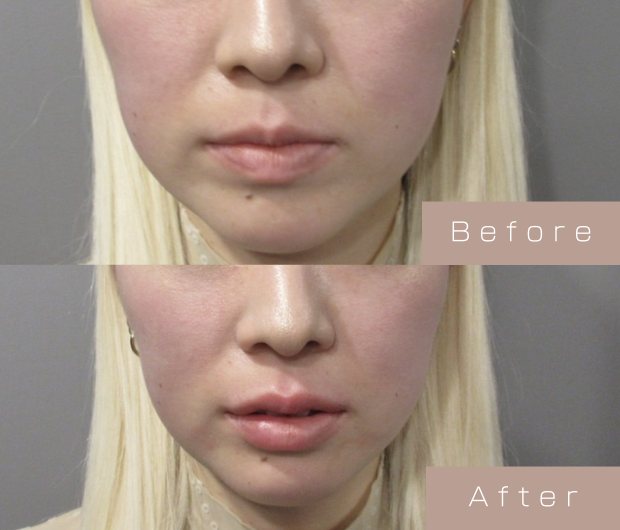 スマイルリップ