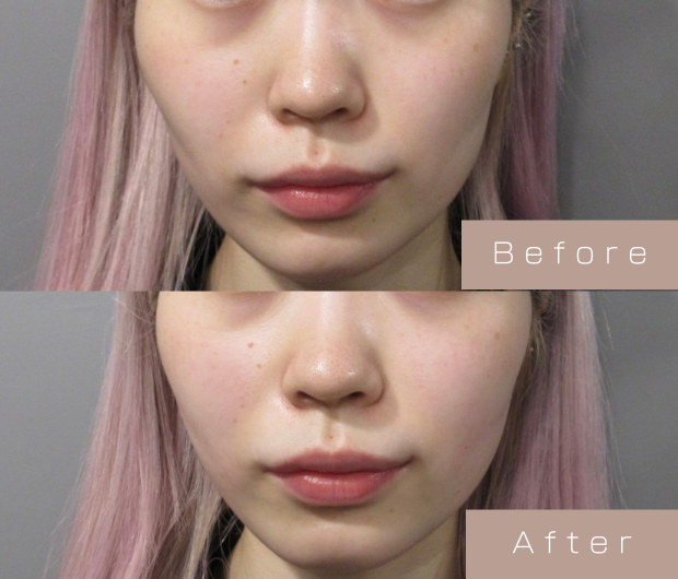 頬ヒアルロン酸