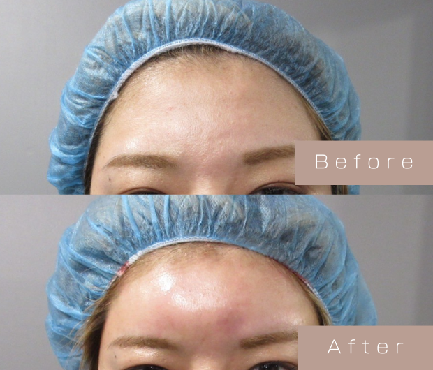 額ヒアルロン酸