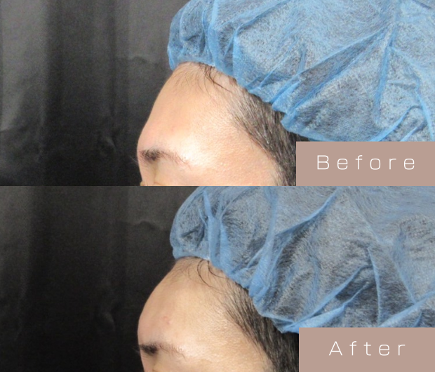 額ヒアルロン酸