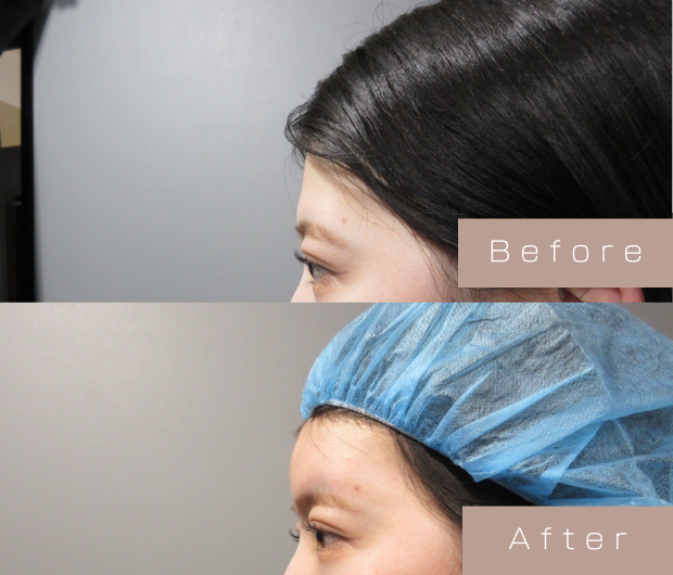 額ヒアルロン酸