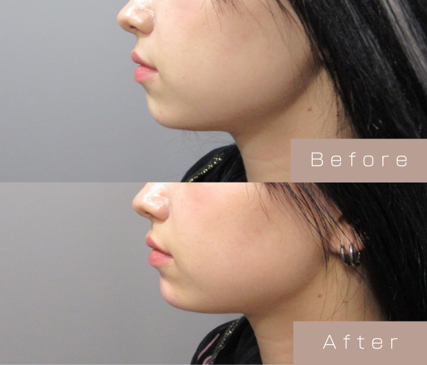 顎ヒアルロン酸