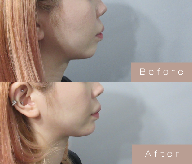 顎ヒアルロン酸