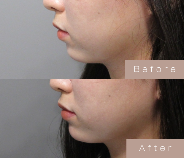 顎ヒアルロン酸