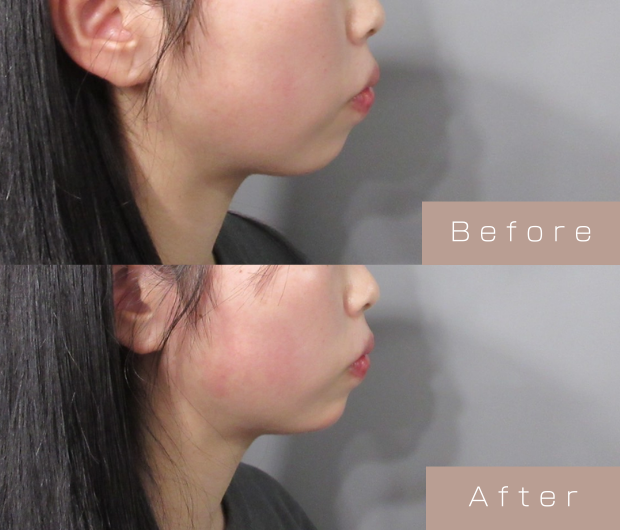 顎ヒアルロン酸