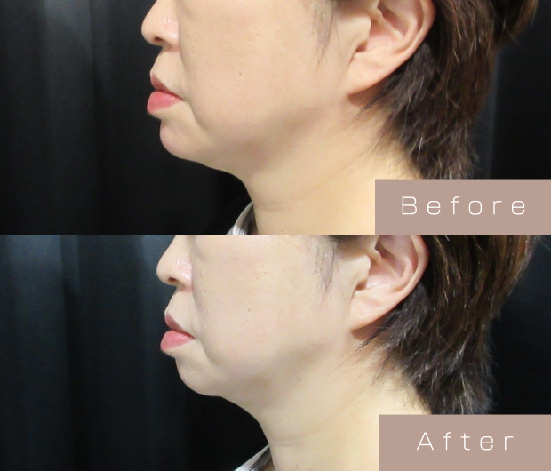 顎ヒアルロン酸