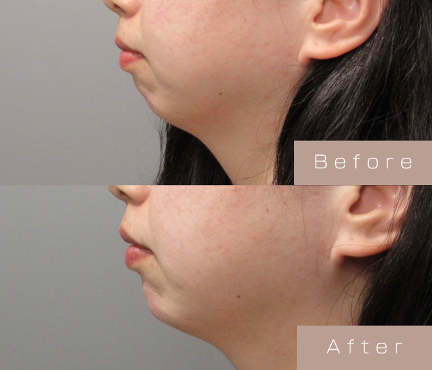 顎ヒアルロン酸