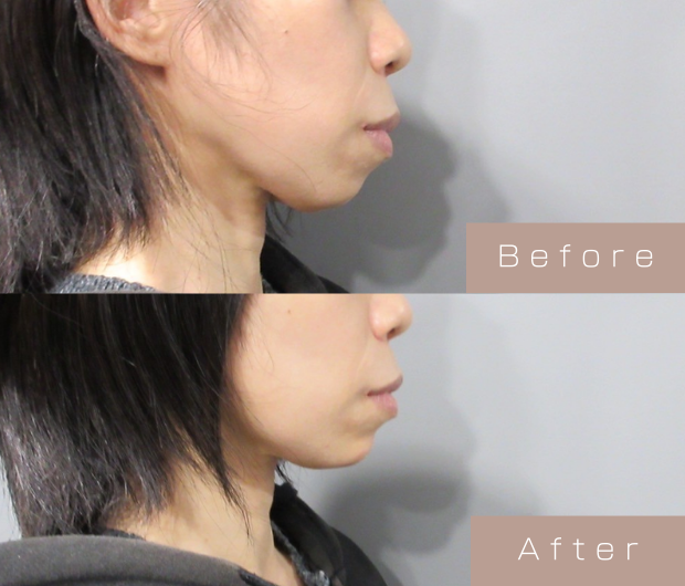 顎ヒアルロン酸