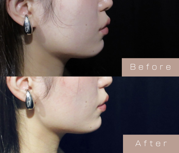 顎ヒアルロン酸