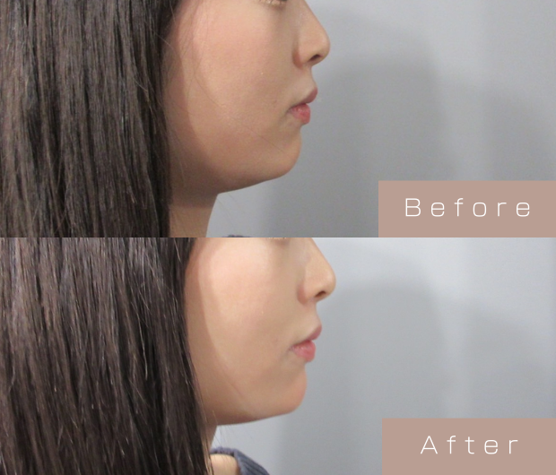 顎ヒアルロン酸