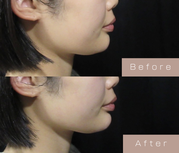 顎ヒアルロン酸