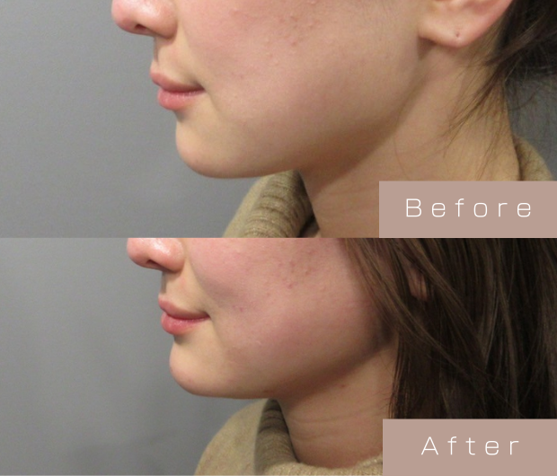 顎ヒアルロン酸