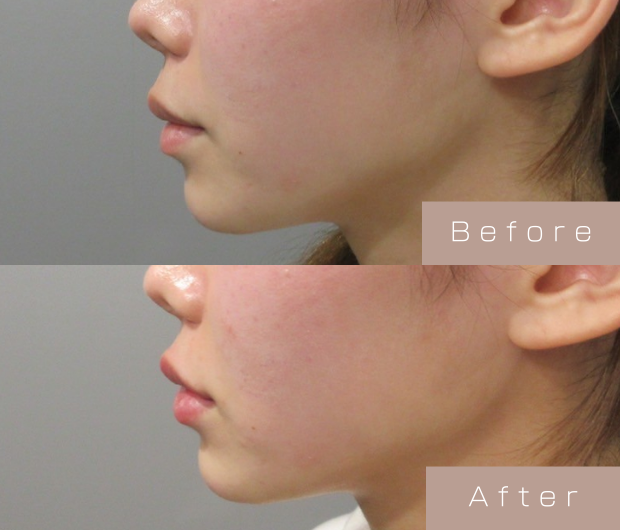 顎ヒアルロン酸