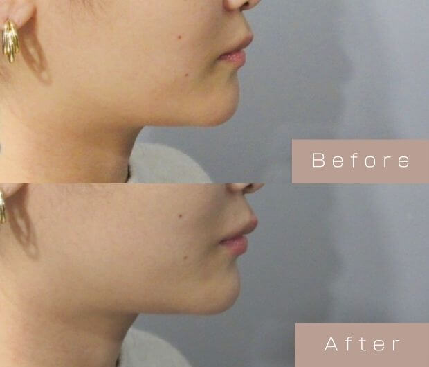 顎ヒアルロン酸