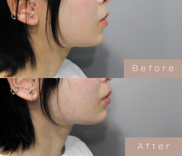 顎ヒアルロン酸