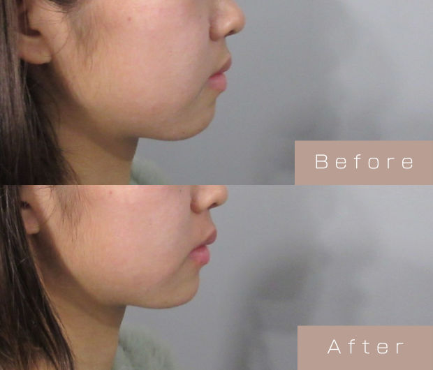 顎ヒアルロン酸