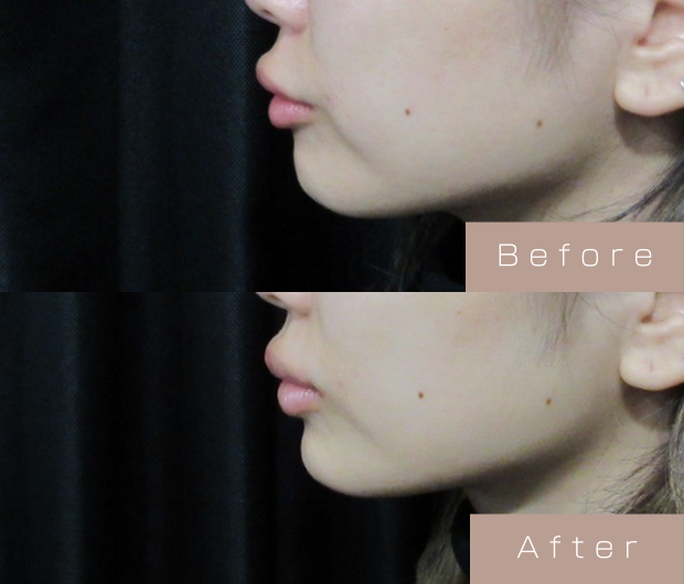 顎ヒアルロン酸