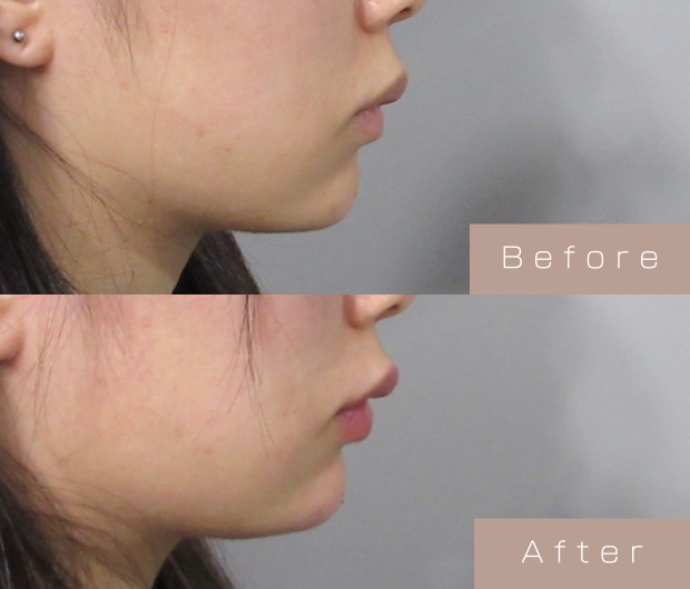 顎ヒアルロン酸