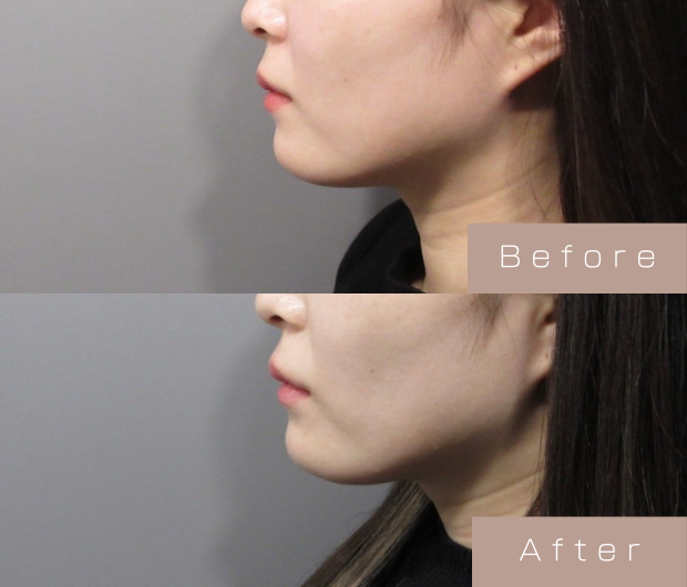 顎ヒアルロン酸