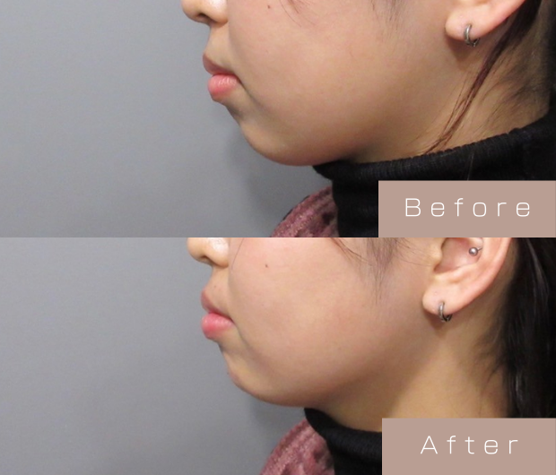 顎ヒアルロン酸