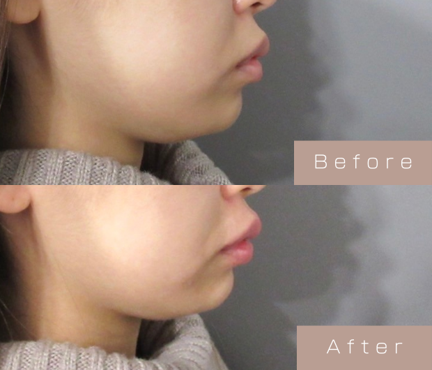 顎ヒアルロン酸