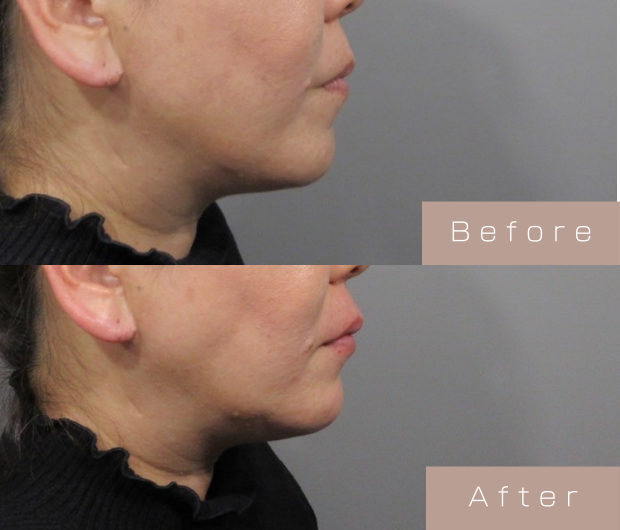 顎ヒアルロン酸