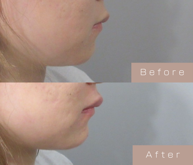 顎ヒアルロン酸