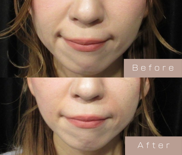 ほうれい線ヒアルロン酸