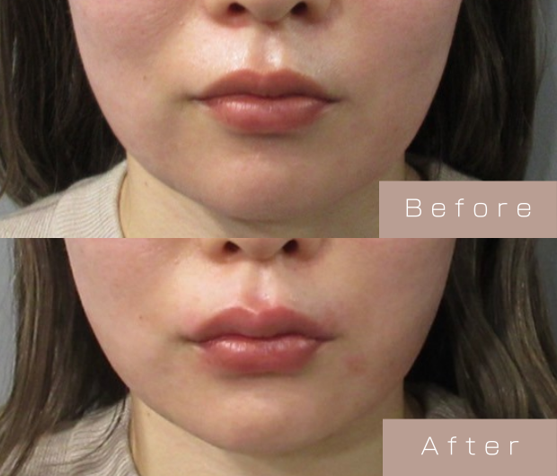 スマイルリップ