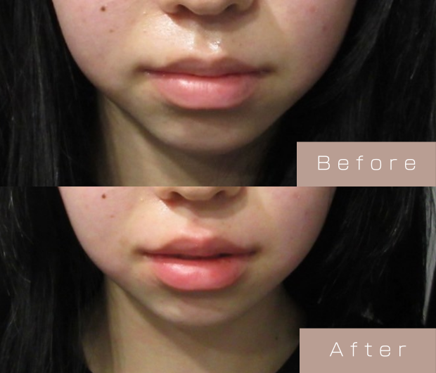 スマイルリップ