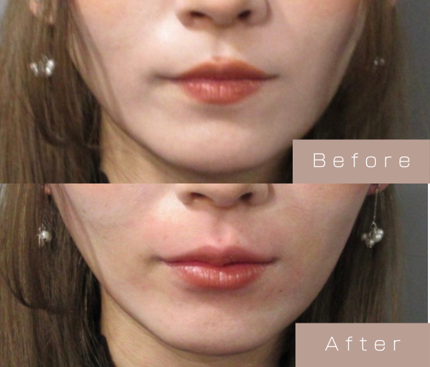 スマイルリップ