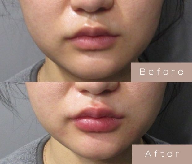 スマイルリップ