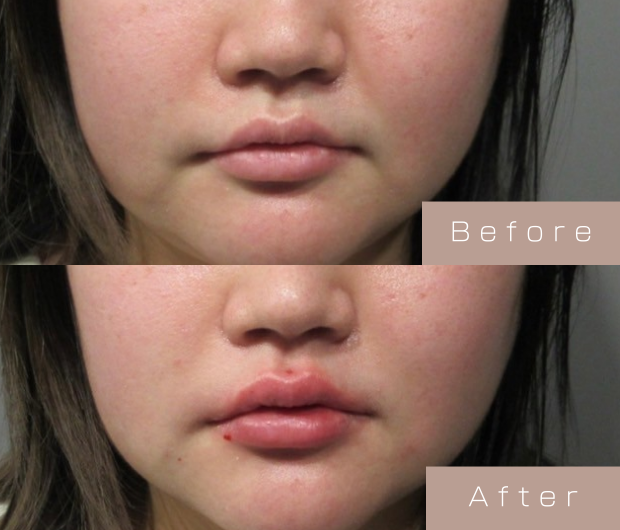 スマイルリップ